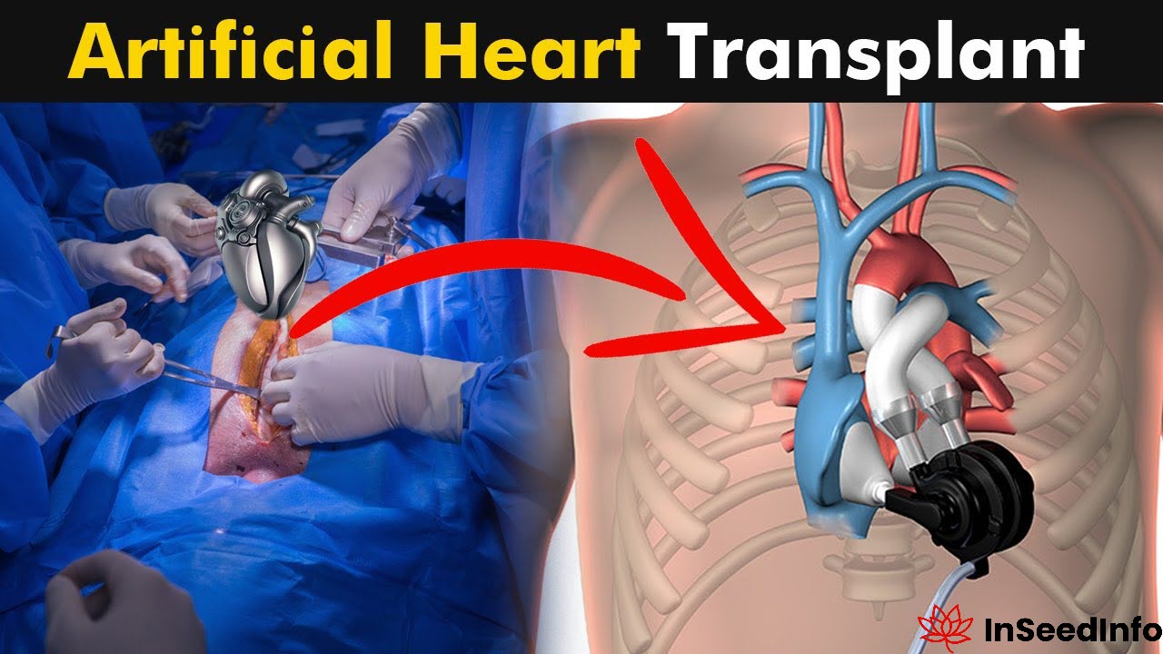 Artificial Heart Transplants Inseed Info